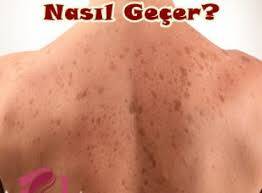 Güneş Lekeleri için Doğal Yöntemler