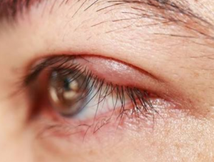 Göz Kapağı İltihabı (Blefarit) Nedir?