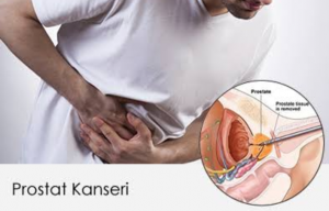 Prostat Kanseri Nedir? Sebepleri ve Tedavi Yöntemleri