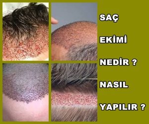 Saç Ekimi Nedir ? Nasıl Yapılır ?