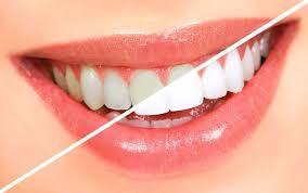 Diş Beyazlatma Hakkında Bilinmesi Gereken Önemli Bilgiler