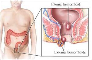 Hemoroid'e İyi Gelecek Bitkisel Tedaviler