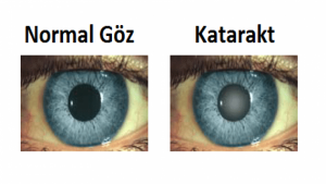 Katarakt Nedir, Belirtileri ve Tedavisi Nasıldır?