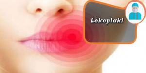 Lökoplaki Nedir, Belirtileri ve Tedavisi Nasıldır ?