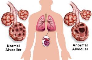 Amfizem Nedir? Korunma Yolları Nelerdir ?