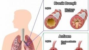Amfizem Nedir? Korunma Yolları Nelerdir ?