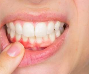 Diş eti Sakız Hastalığı Nedir? Diş etlerini Sağlıklı Tutmanın 6 Ana Yolu Nelerdir?