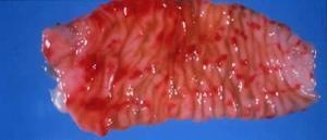 Enterik Campylobacteriosis Nedir?
