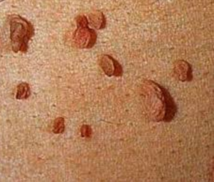 Genital Bölgedeki Siğillere Neler Sebep Olmaktadır? Tedavi Süresi ve Yolları Nelerdir? 