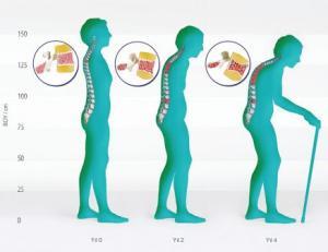 Süt Tüketimi ve Osteoporoz İlişkisi