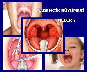 Bademcik Büyümesi Nedir ? Tedavisi Nasıldır ?