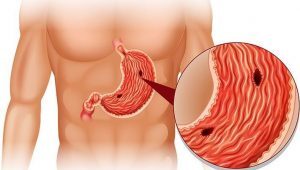Mide ve Onikiparmak Bağırsağı Ülseri (Peptik Ülser) Nedir, Belirtileri ve Tedavisi Nasıldır?