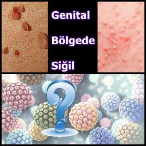 Genital Bölgedeki Siğillere Neler Sebep Olmaktadır? Tedavi Süresi ve Yolları Nelerdir? 
