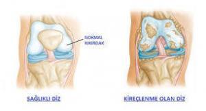 Eklem Kireçlenmesi (Osteoartroz) Nedir, Belirtileri ve Tedavisi Nasıldır?
