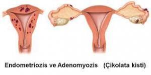 Endometriyozis Nedir, Belirtileri ve Tedavisi Nasıldır ?