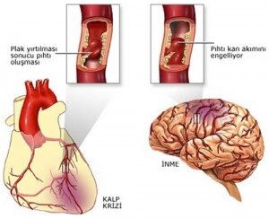 Felç (İnme) Neden Olur ? Tıbbi Tedavi Yöntemleri Nelerdir ?