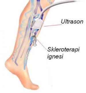 Skleroterapi Nedir?