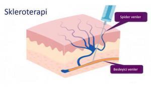 Skleroterapi Nedir?
