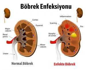 Böbrek Enfeksiyonu Nedir? Böbrek Enfeksiyonu Belirtileri Önlemek İçin İpuçları