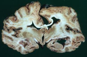 Prion Nedir ve Hastalıklara Nasıl Neden Olur?