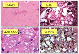 Prion Nedir ve Hastalıklara Nasıl Neden Olur?