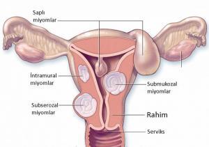 Rahimde Miyom Neden Oluşur ? Miyom Çeşitleri, Belirtileri ve Tedavisi