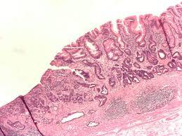 Metaplazi Hücre  ve İntestinal Metaplazi  Nedir ?