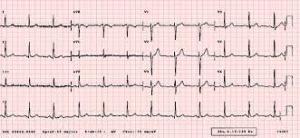 EKG Nedir? Neden ve Nasıl Çekilir?