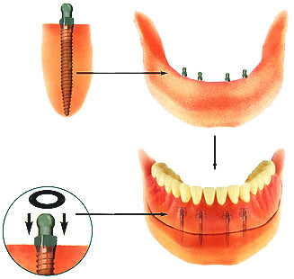Diş Tedavisinde Kullanılan Biyomalzemeler