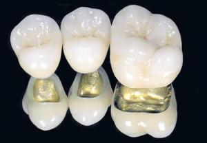 Metalden Yapılan Biyomalzemeler ve Kullanım Alanları