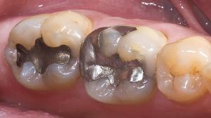 Metalden Yapılan Biyomalzemeler ve Kullanım Alanları