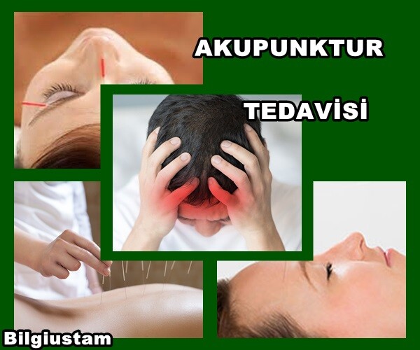 Baş Ağrısı ve Migren için Akupunktur Tedavisi