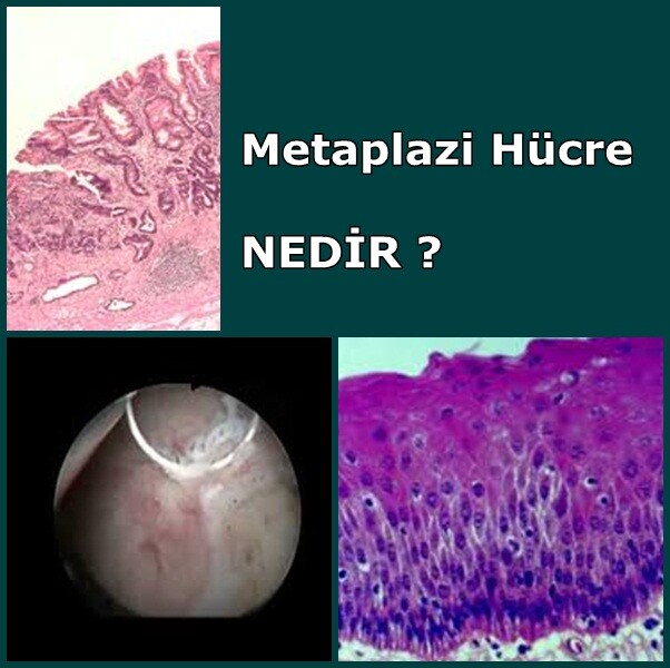 Metaplazi Hücre  ve İntestinal Metaplazi  Nedir ?