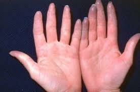 Raynaud Hastalığı Nedir? Belirtileri ve Tedavi Yolları Nelerdir?