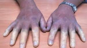 Raynaud Hastalığı Nedir? Belirtileri ve Tedavi Yolları Nelerdir?