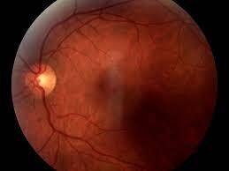 Optik Nörit Nedir?