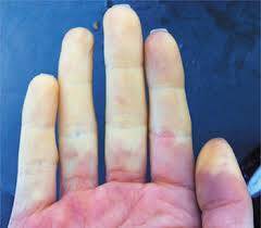 Raynaud Hastalığı Nedir? Belirtileri ve Tedavi Yolları Nelerdir?