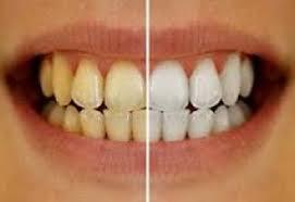 Diş Sararmasının Nedenleri ve Doğal Çözüm Yolları