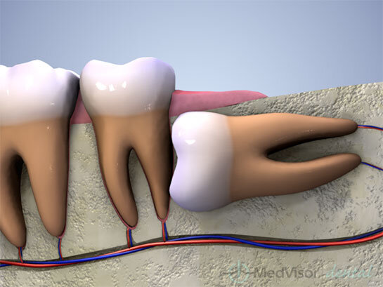 Yirmilik Dişler ve Yol Açtığı Sağlık Sorunları
