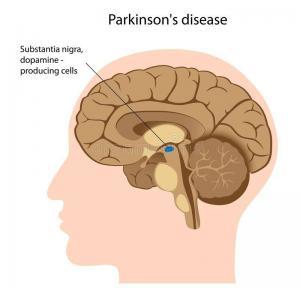 Parkinson Hastalığına Neden Olan Molek&uuml;ler Mekanizmalar