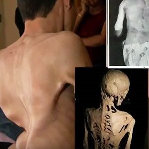 Taş Adam Sendromu Nedir?