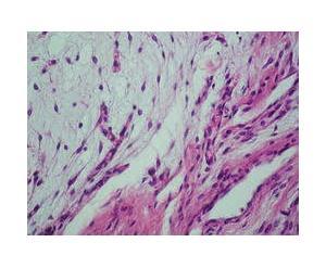 İdiopatik Pulmoner Fibrozis (İPF) Nedir?