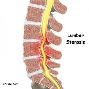 Spinal Stenoz (Kanal Darlığı) Nedir?