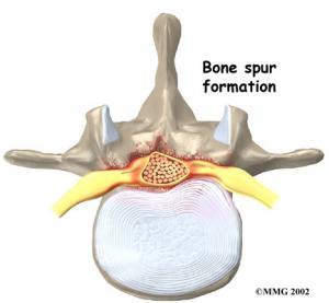 Spinal Stenoz (Kanal Darlığı) Nedir?