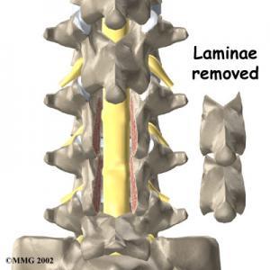 Spinal Stenoz (Kanal Darlığı) Nedir?