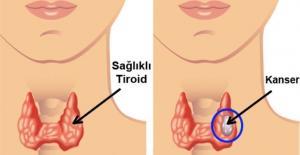 Tiroid Bozuklukları ve Sorunları