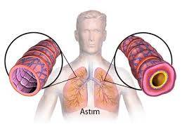 Astım Nedir? Belirtileri Nelerdir?