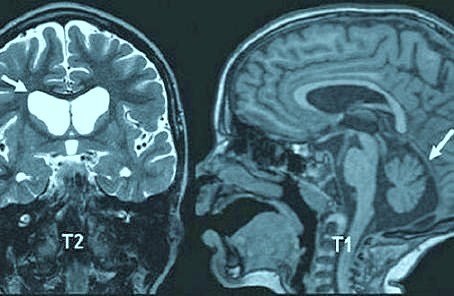 Nörodejeneratif Huntington Hastalığının Tedavisi Var mı?