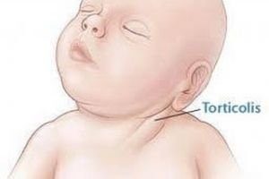 Tortikolis Belirtileri ve Tedavisi