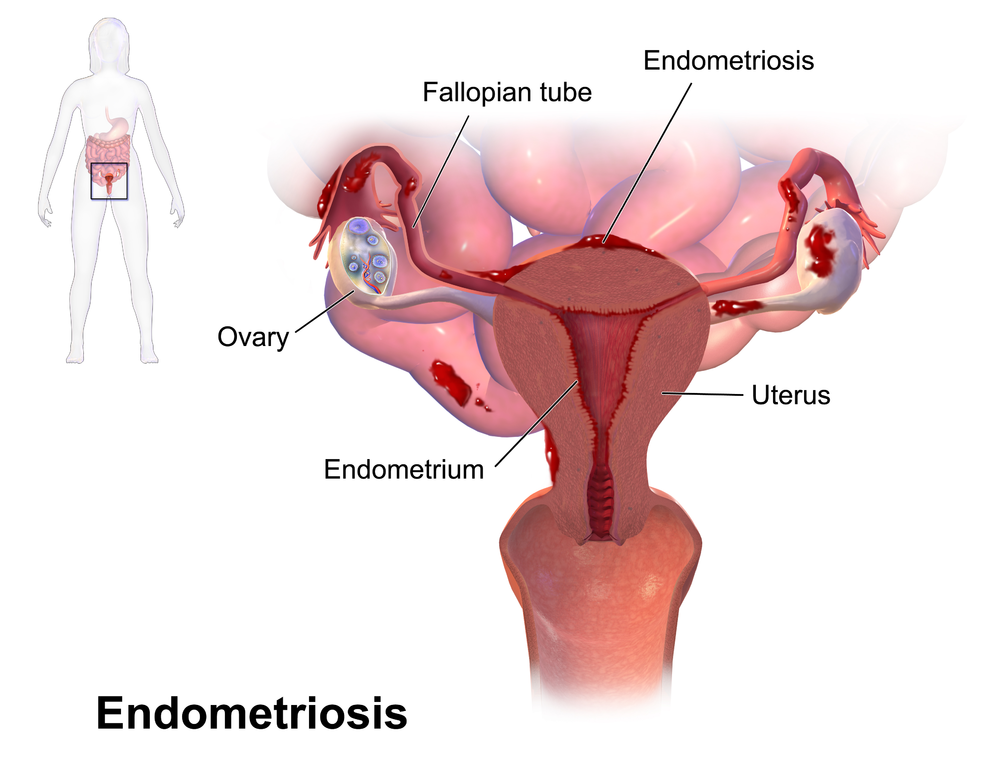 Çikolata Kisti (Endometriozis) Nedir? Kısırlığa Yol Açar mı?